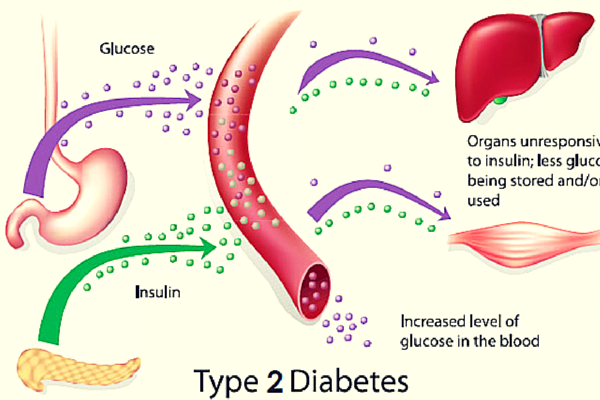 diabetes type 2 