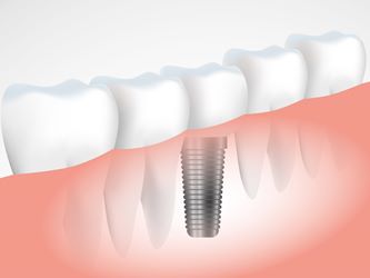 Dental Implant Featured Image