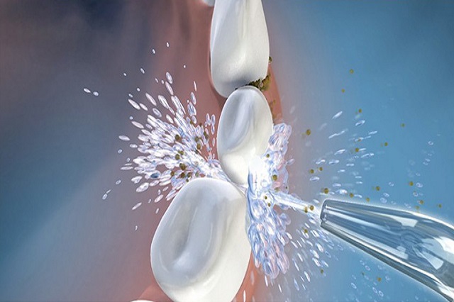 7 Benefits Of Water Flosser You Should Know 7 Benefits Of Water Flosser You Should Know