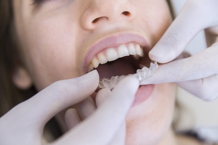 Teeth Aligning