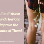 What Are Varicose Veins and How Can You Improve the Appearance of Them?