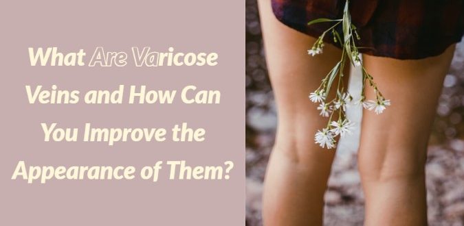 Varicose Veins