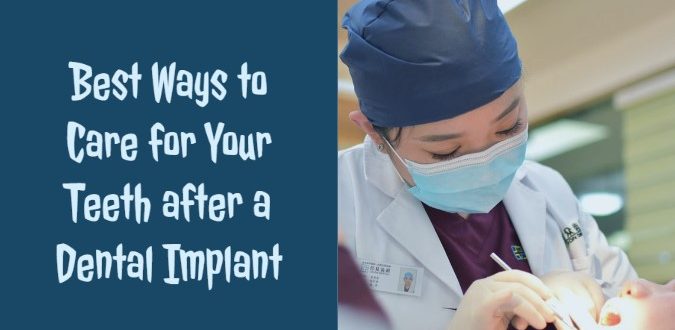Care for Your Teeth after a Dental Implant