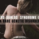 EHLERS-DANLOS  SYNDROME (EDS): A Rare Genetic Disorder