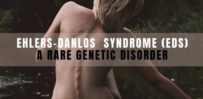 EHLERS-DANLOS SYNDROME