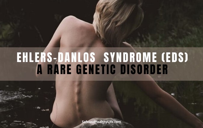 EHLERS-DANLOS SYNDROME