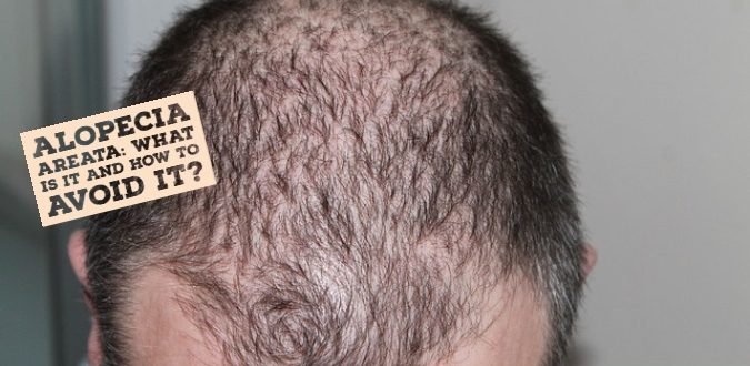 Alopecia Areata