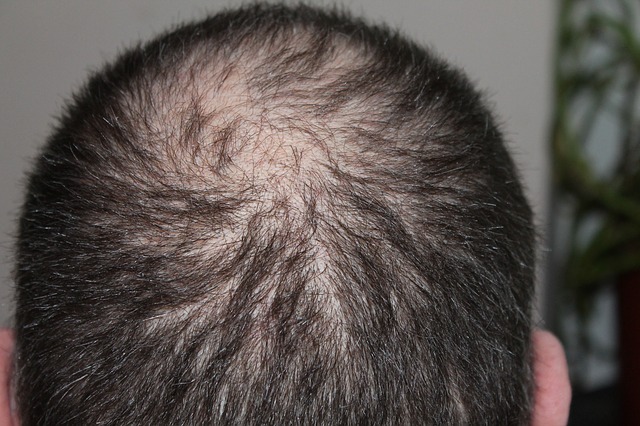 Causes of triggering Alopecia