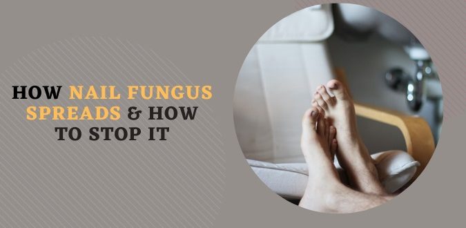 Nail Fungus Spreads