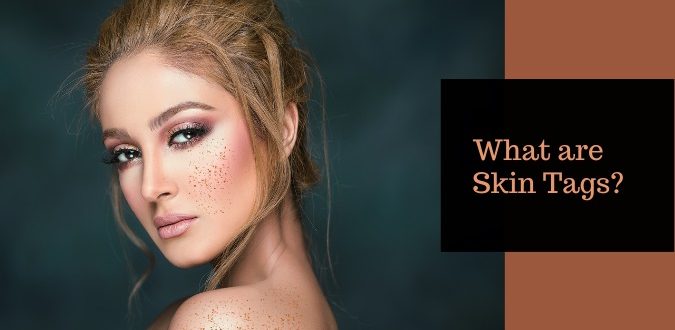 Skin Tags