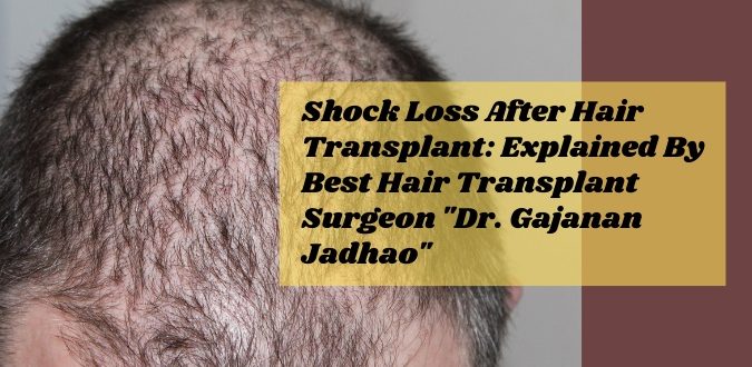 Shock Loss After Hair Transplant