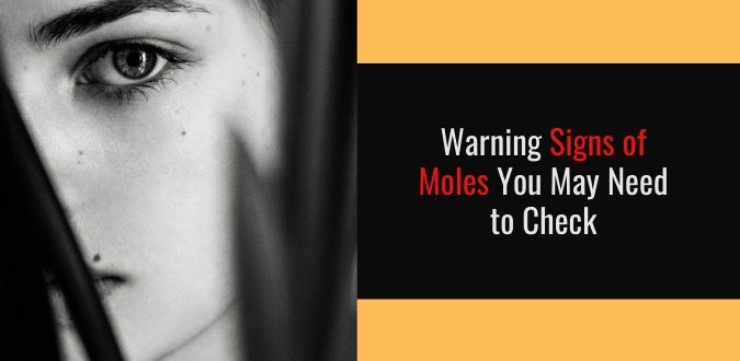 Warning Signs of Moles