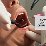 Dentist Fix a Chipped Tooth