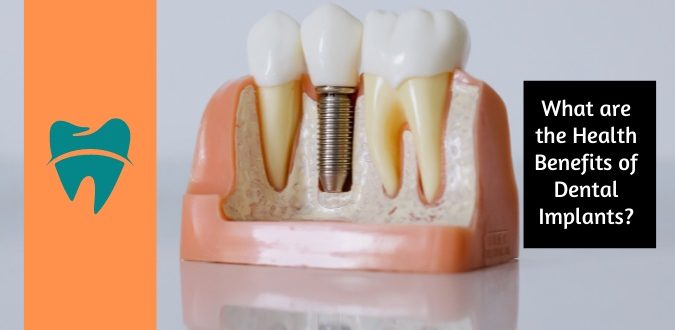 Health Benefits of Dental Implants