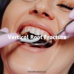 Vertical Root Fracture