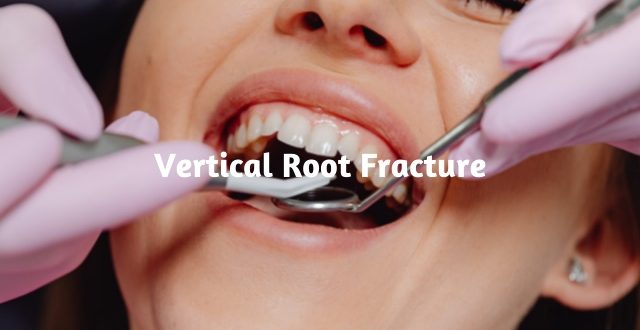 Vertical Root Fracture