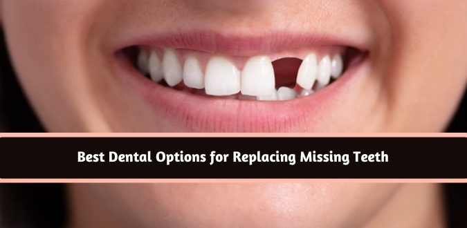Dental Options for Replacing Missing Teeth