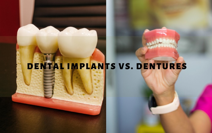 Pros and Cons of Dental Implants vs. Dentures