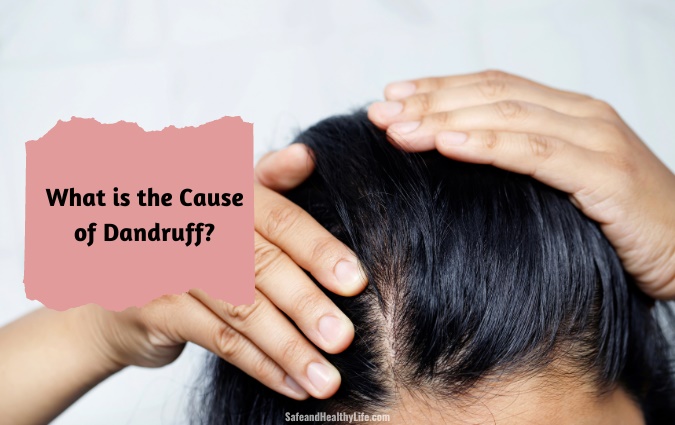 What is the Cause of Dandruff?