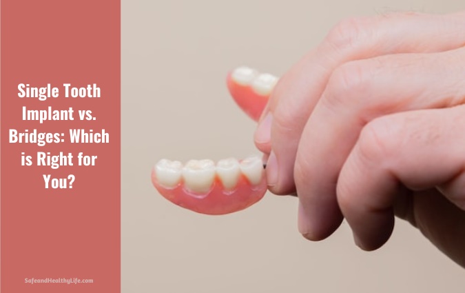 Single Tooth Implant vs. Bridges