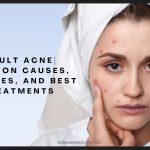 [Adult Acne] Common Causes, Remedies, and Best Treatments