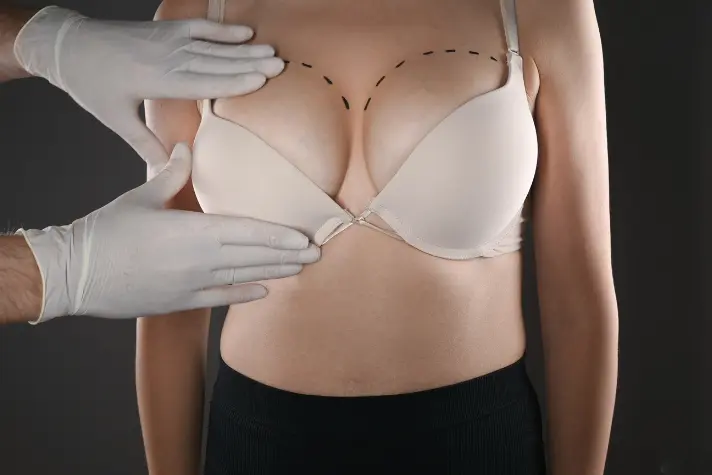 Subglandular Implant Placement