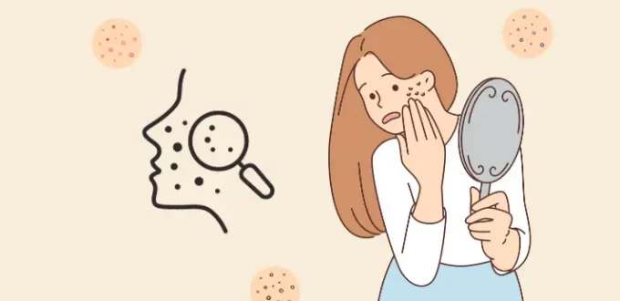 How to Treat Acne Scars