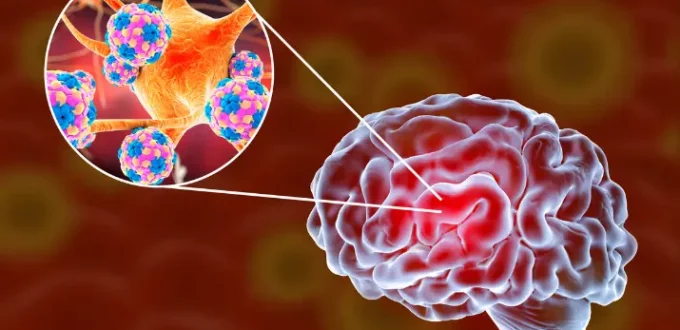 Meningitis: Everything You Need To Know