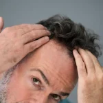 A Look Into Solutions and Alternatives for Men's Hair Loss A Look Into Solutions and Alternatives for Men's Hair Loss
