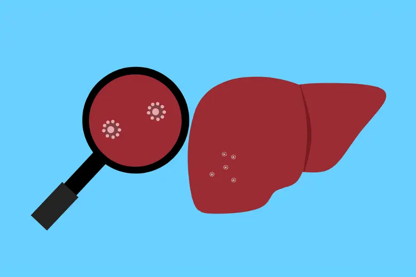 Jaundice: A Telltale Indicator