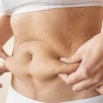 Transform Your Curves: The Truth About Plus Size Liposuction