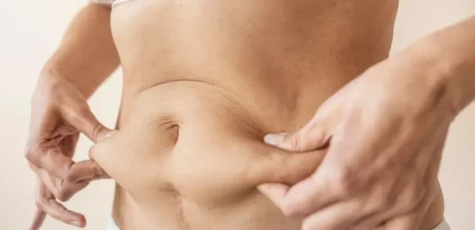 Transform Your Curves: The Truth About Plus Size Liposuction