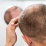 Navigating Alopecia: A Look at Immune Systems and Hair Loss