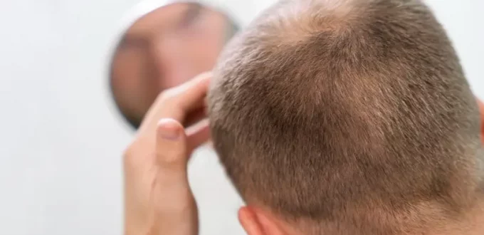 Navigating Alopecia: A Look at Immune Systems and Hair Loss